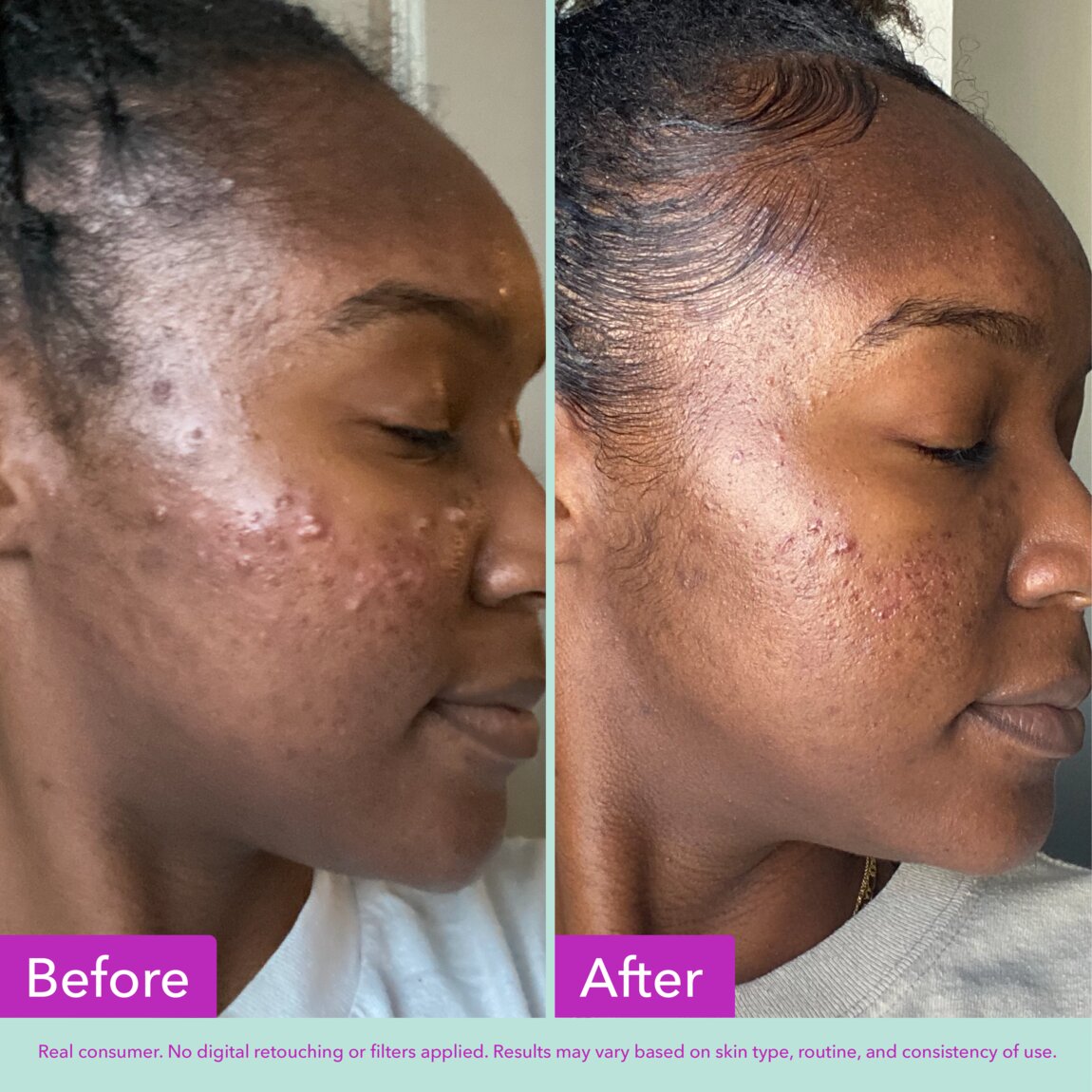 acne-foaming-cleanser-c3 zb_p.jpg