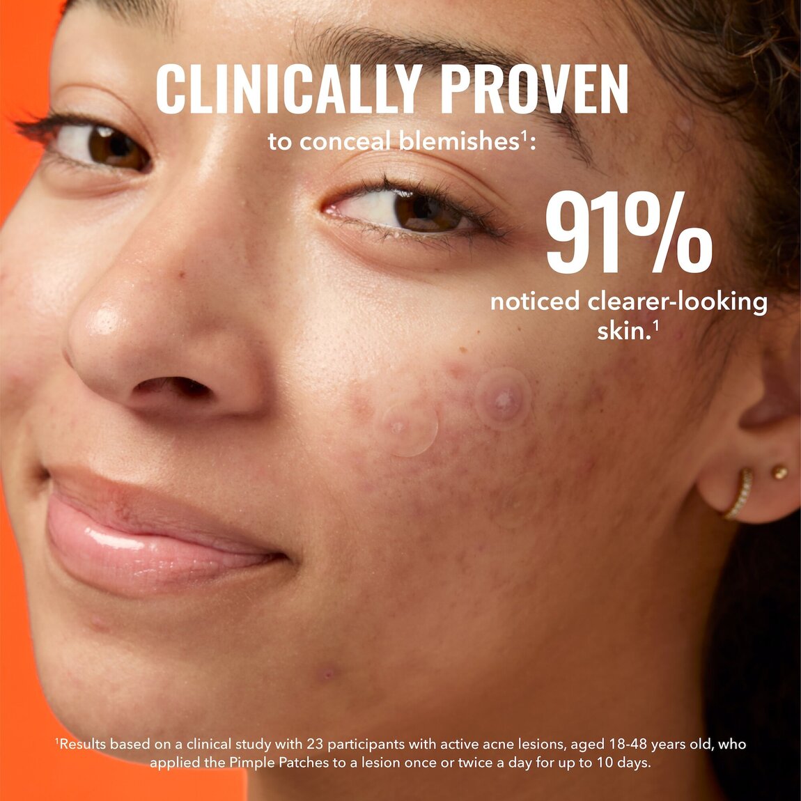 pimple-patches-y5 zb_p.jpg